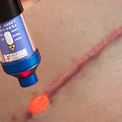 zachte lasertherapie en zachte laserapparatuur