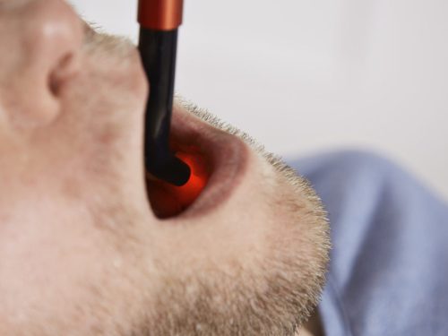 Energy-Laser L500 Pro softlaser