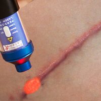 Therapeutische laser