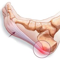 Plantaire fasciitis