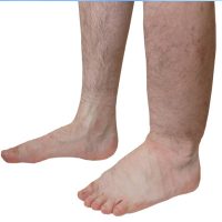 Zwelling van de benen