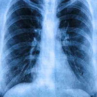 Cystische fibrose (taaislijmziekte)