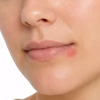 Herpes (koortslip)