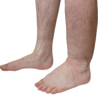 Bloedvaten- en lymfeaandoeningen