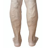 Behandeling van spataderen