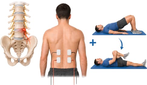 Spierstimulatie en fysiotherapie bij de revalidatie van een hernia