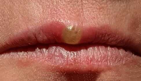 Lipherpes softlaserbehandeling – Casestudy met foto’s