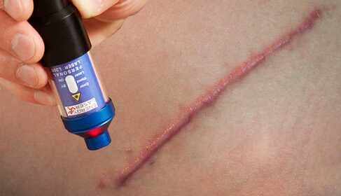 Lasertherapie voor littekens en keloïden – Thuistherapie