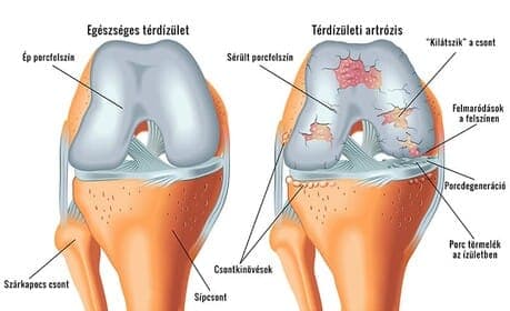 Knie-artrose – veelvoorkomende gewrichtsaandoening