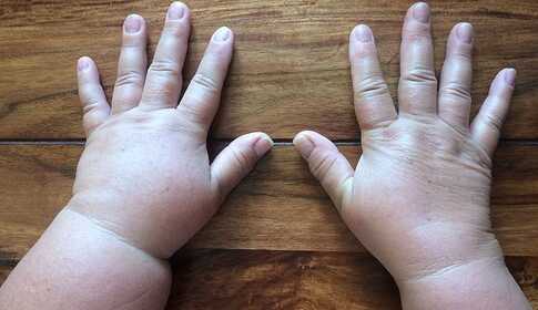 Behandeling van lymfoedeem thuis