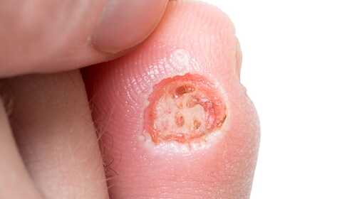 Behandeling van de diabetische voet thuis