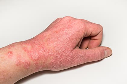 Dermatologische problemen en zouttherapie – Aanvulling bij de behandeling van eczeem en psoriasis