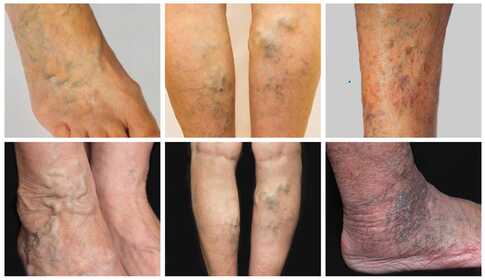 Onderbeenulcus – genezing met spierstimulatie