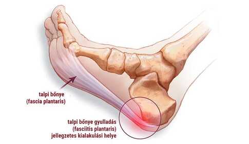 Ontsteking van de plantaire fascie, oftewel plantar fasciitis