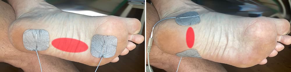 behandeling van plantaire fascie, fasciitis plantaris, hielspoor met microstroom