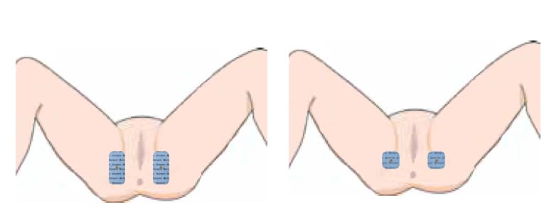 Behandeling incontinentie – dijbasis elektrodeplaatsing