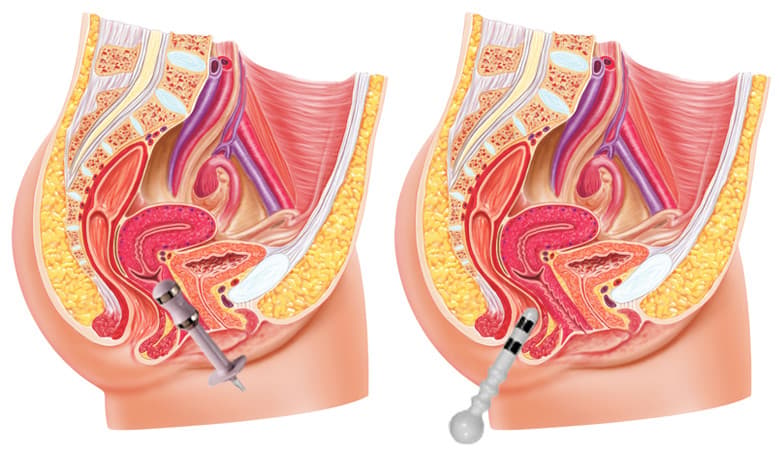 Behandeling incontinentie – vaginaal en anaal sondeposities