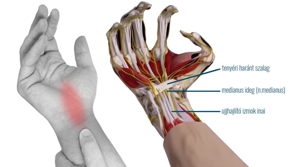 csukloalagut-szindroma-carpal-tunnel.jpg