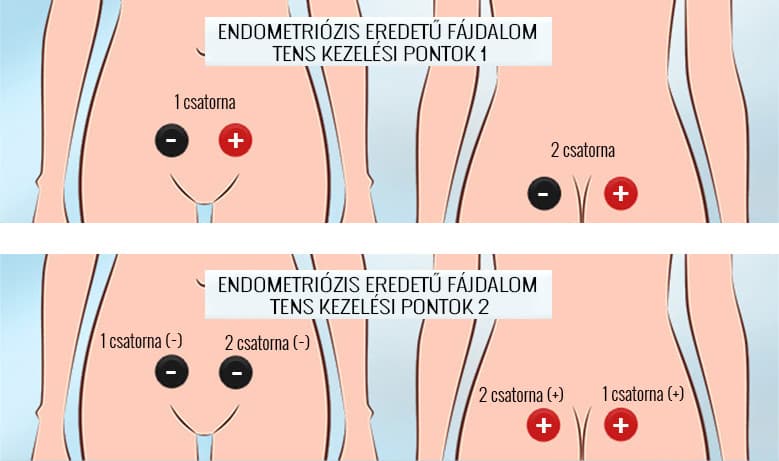 endometriozis-fajdalom-kezelesi-pontok.jpg