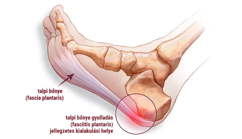 ontsteking van de plantaire fascie, fasciitis plantaris